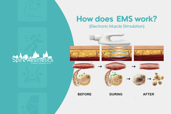 EMS treatment for post pregnancy weight loss treatment Anniesland