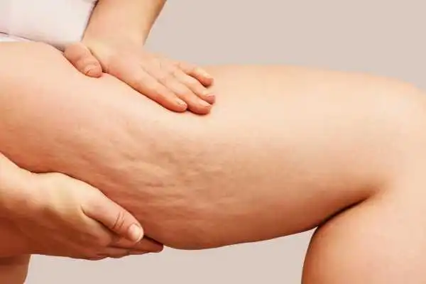 Image of woman showing leg with cellulite Anniesland