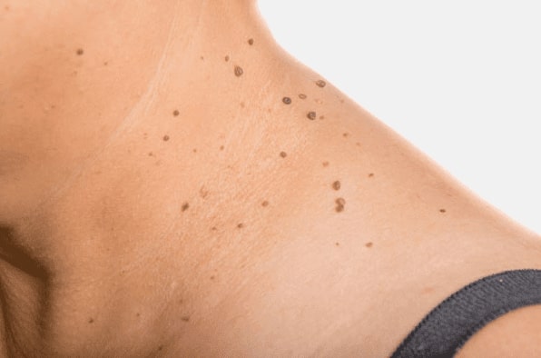 Are you looking for easy skin tag removal Anniesland - then contact Spire today!