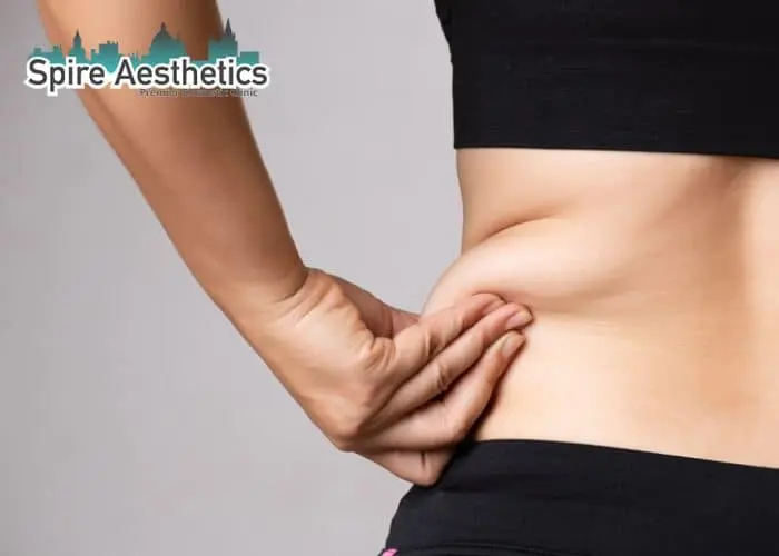 Image of woman pinching fat on their hips Anniesland. Fat Freezing treatment
