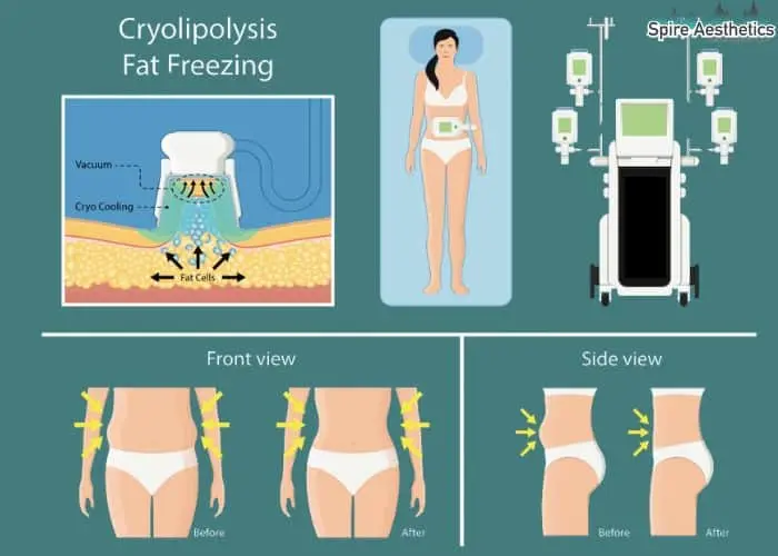 Fat freezing treatment Anniesland benefits for competitions to remove stubborn fat deposits.