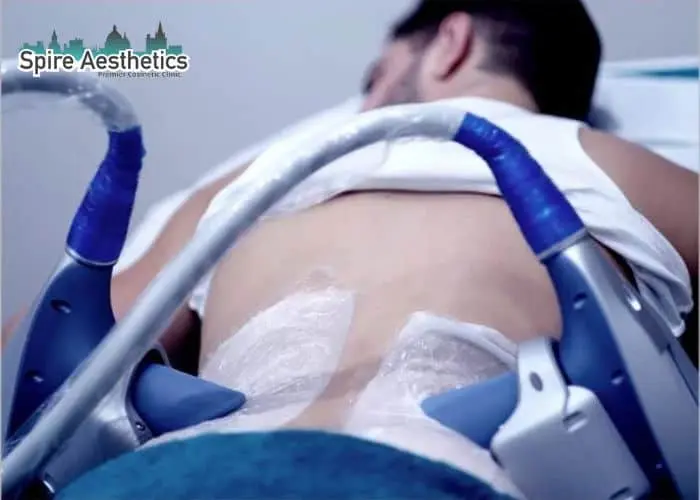 Man having fat freezing treatment done on love handles before a competitions Anniesland to create a sculpted look.