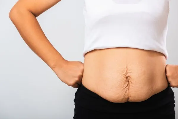 Image of a woman's stomach after weight loss with sagging skin following a gastric band Anniesland